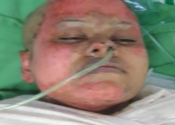 সাবেক স্বামীর দেয়া আগুনে নারী চিকিৎসক দগ্ধ