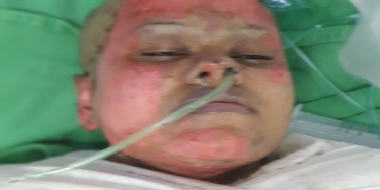 সাবেক স্বামীর দেয়া আগুনে নারী চিকিৎসক দগ্ধ