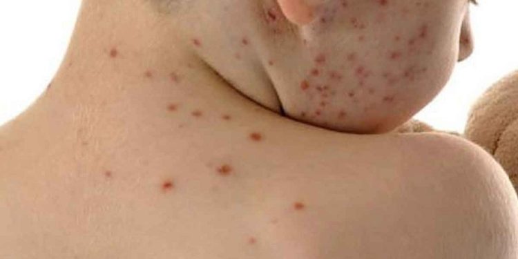 টিকা নেওয়ার আগেই হামে রোগে আক্রান্ত বেশিরভাগ শিশু!