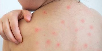 বাবা-মায়ের যে ৭ ভুলে হাম নিয়ে হতে পারে মারাত্মক বিপদ