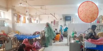 হামে আক্রান্ত হয়ে ১৫ জনের মৃত্যু